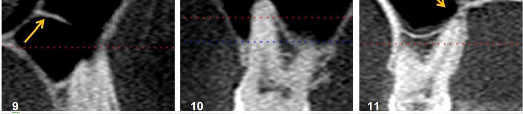 Reformatação parassagital evidenciando uma cúpula alveolar no SM, lado direito. Figura 11.