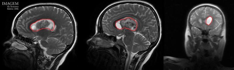 Imagem 3: Na RM, observa-se lesão de aspecto heterogêneo, contorno arredondado, em topografia ventricular supratentorial (demarcado em vermelho).