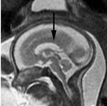 A APLICABILIDADE DO EXAME DE RESSONÂNCIA MAGNÉTICA FETAL, COMO COMPLEMENTAÇÃO DE ULTRASSONOGRAFIA FETAL THE APPLICABILITY OF THE FETAL MAGNETIC RESONANCE EXAMINATION, AS COMPLEMENTATION OF FETAL