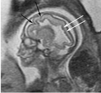 Plano sagital Diversas invaginações anormais no córtex demonstrado pelas setas pretas. O ventrículo lateral possui formas anormais e ondulações, demonstradas pelas setas brancas.