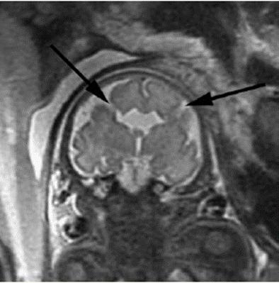 MONIQUE RESENDE PRADO, KARLA ALVES Figura 6 - Feto com 33 semanas. Possui fendas bilaterais que se estendem do ventrículo para o espaço subaracnoide. As setas indicam esquizencefalia.