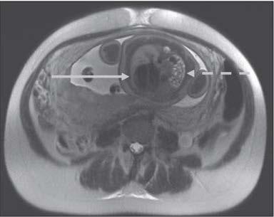 A APLICABILIDADE DO EXAME DE RESSONÂNCIA MAGNÉTICA FETAL, COMO COMPLEMENTAÇÃO DE ULTRASSONOGRAFIA FETAL THE APPLICABILITY OF THE FETAL MAGNETIC RESONANCE EXAMINATION, AS COMPLEMENTATION OF FETAL