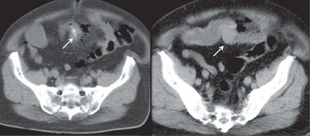 Três dos pacientes utilizavam prótese dentária e em um deles o corpo estranho perfurou o intestino em uma área de estreitamento secundário à presença de um tumor neuroendócrino na parede intestinal