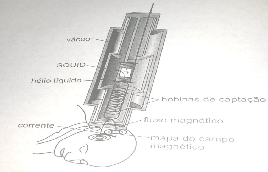 A técnica médica mais disseminada que usa um SQUID é a magnetoencefalografia (ver figura 35), que detecta os fracos campo magnéticos gerados por correntes elétricas produzidas em eventos no cérebro.