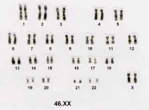 HISTÓRICO 1955 JOE HIN TJIO Definiu como 46 o número exato de cromossomos