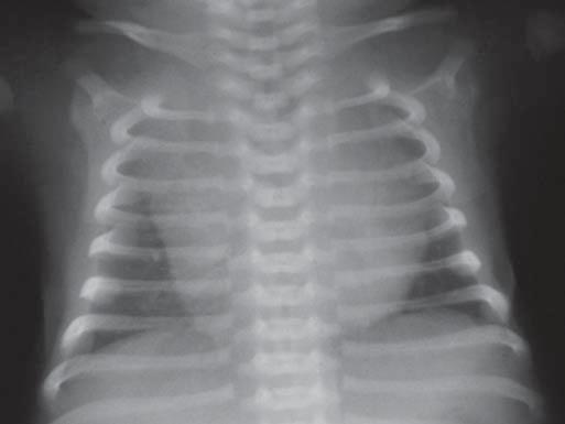 Na incidência ântero-posterior, a largura normal da imagem tímica deve ser igual ou superior ao dobro da largura da terceira vértebra torácica, e dimensões inferiores a esta representam um sinal de