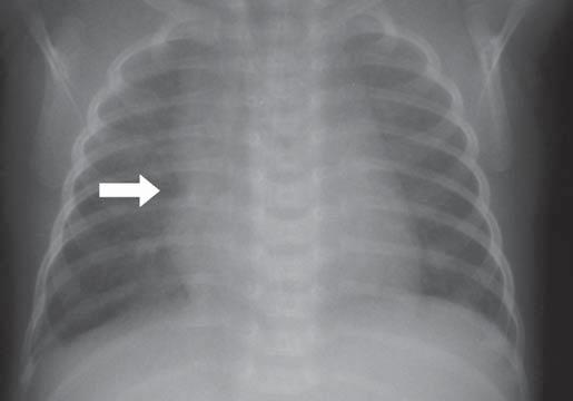 Radiografias de tórax de RN com três horas de vida (A) e com quatro dias de vida (B)