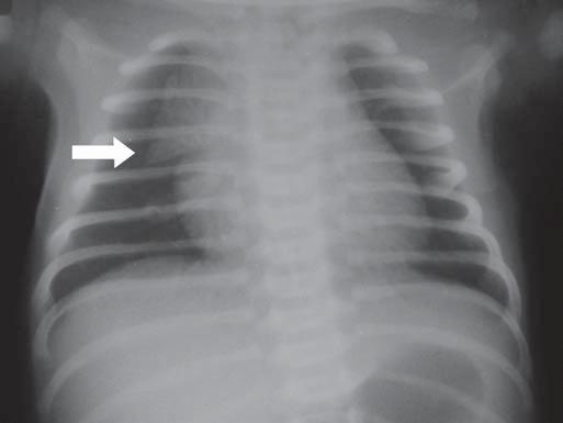 arterial, no lado esquerdo dos corpos vertebrais de T6 a T10 (localização alta) (2,12) (Figuras 13 e 14).