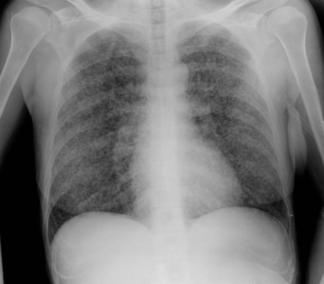 Diminuição transparência pulmonar - Opacidades