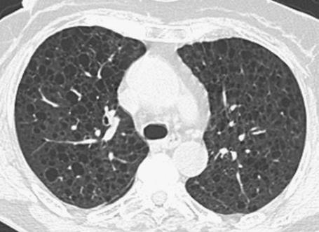 Enfisema: hipertransparência sem