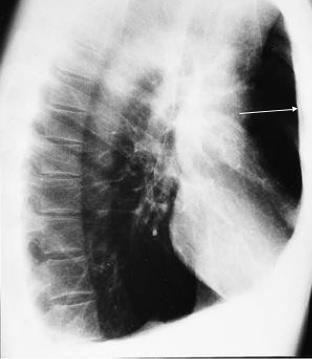 Hipertransparência pulmonar Alargamento e horizontalização dos espaços