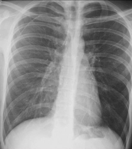 parede torácica Linha da pleura visceral (fina, delimita a superfície pulmonar)