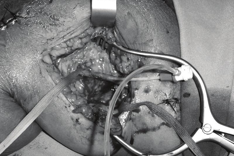 Angioplastia da artéria fibular com cateter-balão Amphirion 3 150 mm e da artéria pediosa com Amphirion 1,5 20 mm. Figura 4.