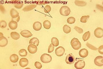Pecilocitose +++ drepanócitos