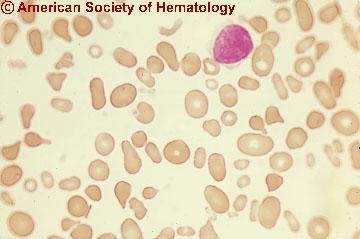 Morfologia anormal de série vermelha Anisocitose +++ Pecilocitose +++ Policromatofilia