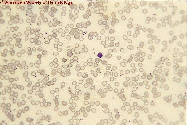 Morfologia anormal de série vermelha * Anisocitose +++