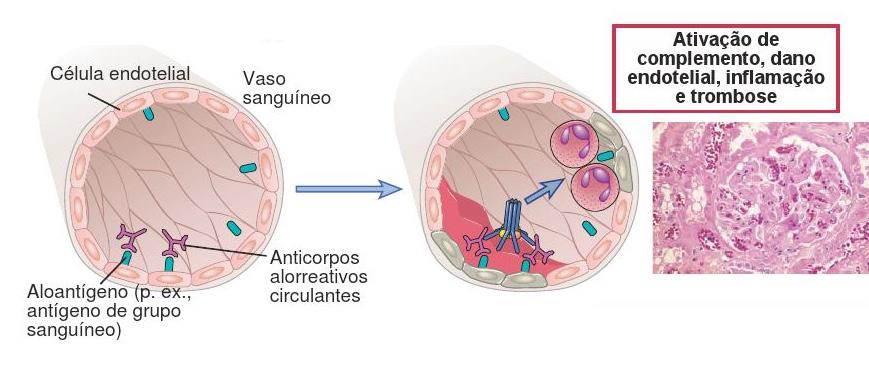 Leitura obrigatória: Tipos de rejeição e doenças autoimunes *Hiperaguda - Ocorre logo após a implantação do órgão e se deve à