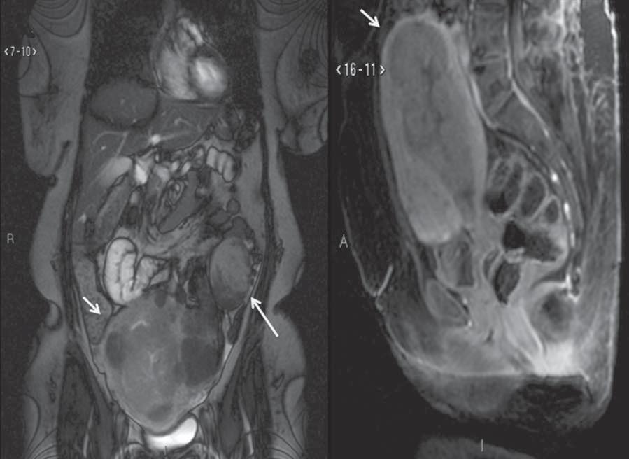 A B Figura 3. Imagem de RM solicitada para diagnóstico de lesão anexial.