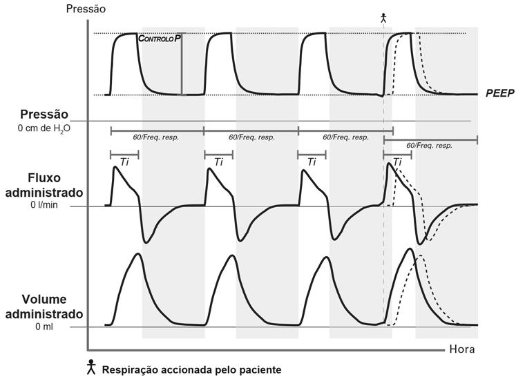 Modos de ventilação Parâmetro Configuração Ti (s) Adulto: 0,2 a 5,0 [1,0] Pediátrico: 0,2 a 5,0 [0,6] Tipo de acionamento Fluxo/Pressão Disponível apenas com circuitos de ramo duplo.