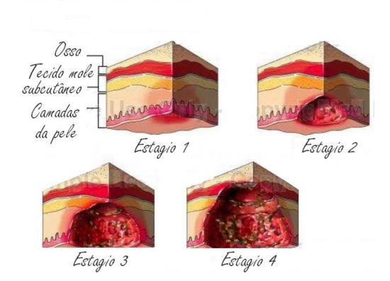 3 pele e tecidos moles de qualquer parte do corpo, usualmente sobre uma proeminência óssea quando são submetidas a uma pressão prolongada 19.