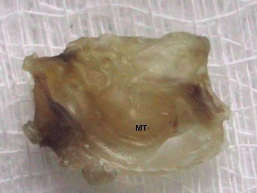 Os cortes então foram analisados com o auxílio de microscópio cirúrgico, com aumento de 16 vezes (X) e 25 vezes, para identificar alterações na membrana timpânica (MT) e na orelha média (OM).