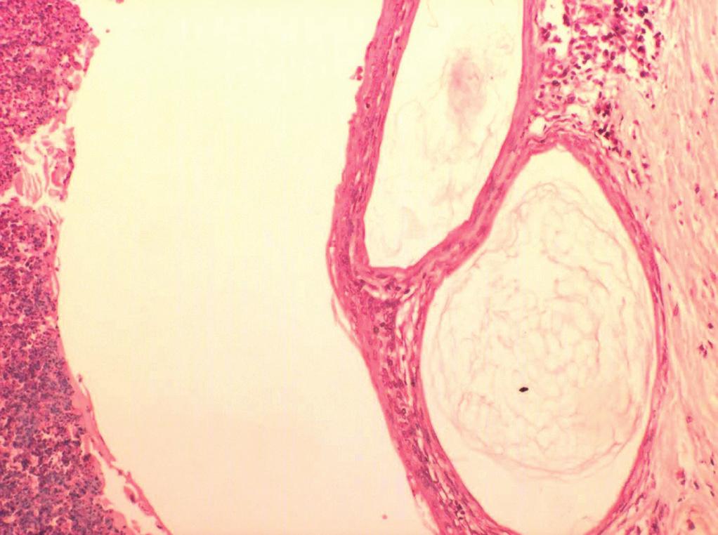 Figura 4. Cistos de Colesteatoma em orelha média (aumento 100 X) - Notar a presença das lamelas de queratina dentro da matriz do colesteatoma. Figura 5.