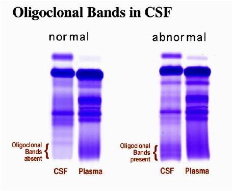 Esclerose Múltipla Diagnóstico Eletroforese de proteínas / Bandas oligoclonais no LCR Imunoglobulinas