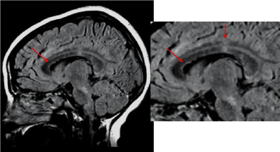 Interface Caloso Septal e