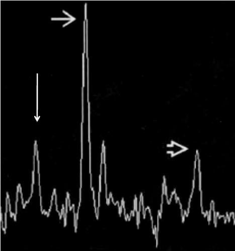 EM - Espectroscopia Aumento de colina Inflamação e desmielinização Redução NAA (n-acetilaspartato) Redução neuronal