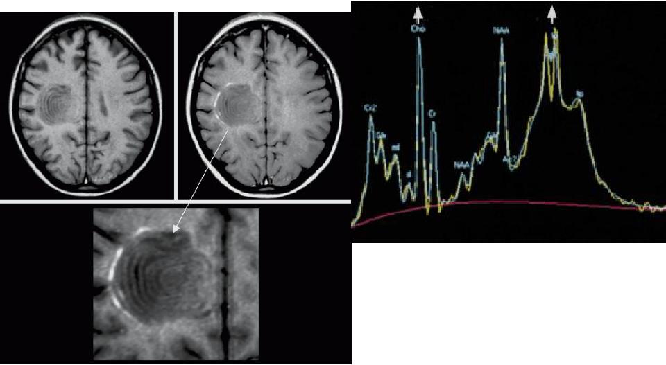 Esclerose Concêntrica de Baló Manutenção NAA Aumento da Cho Aumento Lípides / lactato Cetrus Cetrus