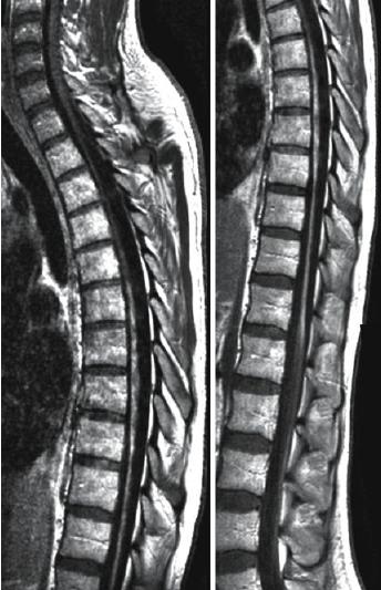 Neuromielite Óptica Sagital T1 pós contraste Se paciente sobrevive à