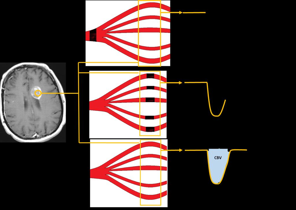 34 Figura 3. Esquema representando a perfusão DSC e o cálculo do CBV.