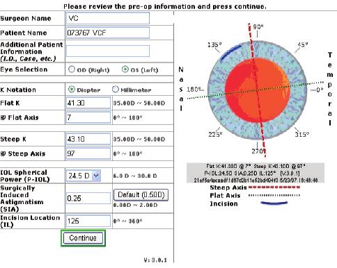 A neutralização do astigmatismo corneano durante a cirurgia da catarata por meio de lente intraocular tórica: resultados 77 INTRODUÇÃO Os (1,7) grandes avanços na biometria permitem que a cirurgia do