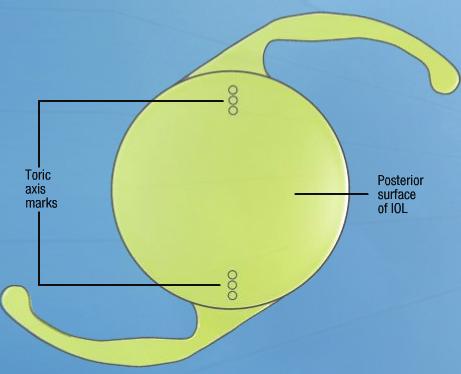 A neutralização do astigmatismo corneano durante a cirurgia da catarata por meio de lente intraocular tórica: resultados 79 Tabela 3 Ceratometria, refração pré e pós-operatória Refração Refração AV