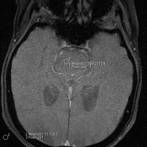 58 Figura 29 RDI 1 no tecido cerebral e RDI 2 no canto inferior esquerdo da imagem. Estas duas regiões de interesse serão utilizadas para encontrar a RSR da imagem. 3.