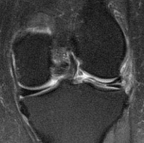 Exame médico Avaliação Clínica É importante contar quando começou os sintomas, se foi relacionado a algum movimento ou pratica esportiva, se apresentou derrame articular e sensação de travamento.