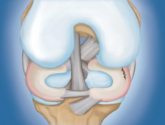 Menisco rompido reparado com suturas Fisioterapia Depois da cirurgia, o médico pode colocar um gesso ou uma órtese no joelho para limitar os movimentos.