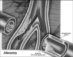 Relacionada com fatores de risco para arteroesclerose Hiperlipidemia Síndrome genética da