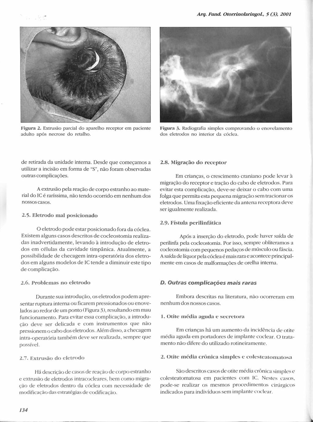 Arq. Fund, OtorrínoIaringoL, 5 (3), 2001 Figura 2. Extrusão parcial do aparelho receptor em paciente adulto após necrose do retalho. Figura 3.