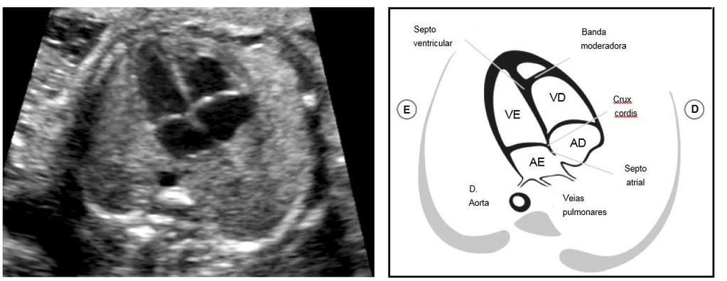 23 Há aproximadamente 10 estudos na literatura descrevendo o desempenho da ecocardiografia fetal precoce na detecção das CCs.