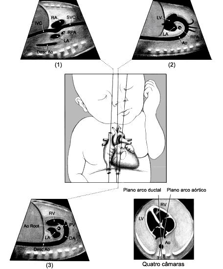 30 RV: ventrículo direito; SVC: veia cava superior; Tra: traqueia. (Modificado de Donofrio e cols., 2014).