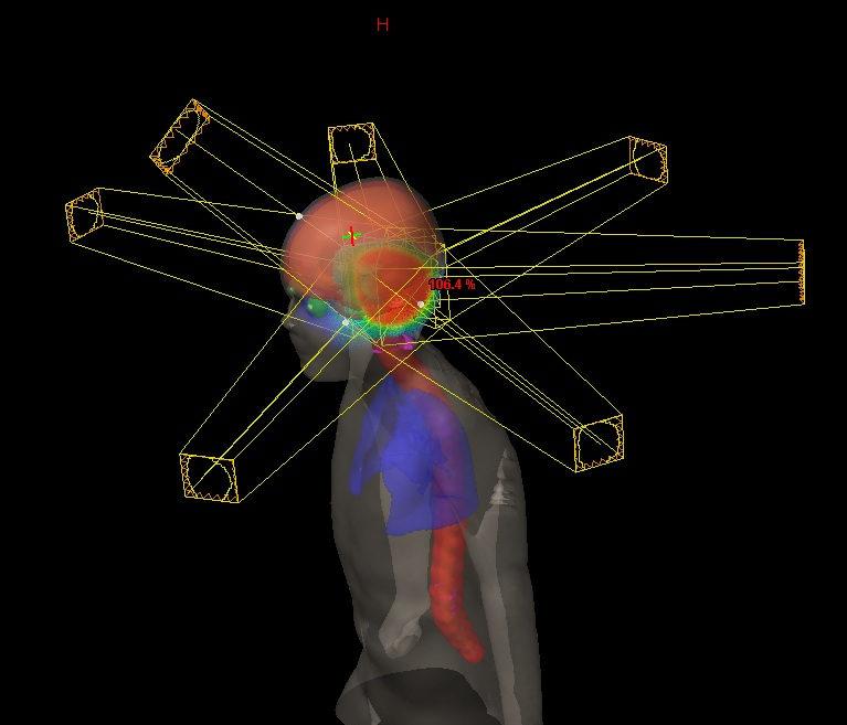 Intensity-modulated radiation therapy for pediatric medulloblastoma: early report on the reduction of ototoxicity.