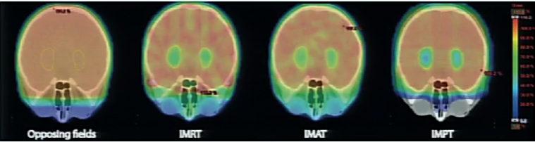 3D X IMRT X IMAT X IMPT Comparação de Técnicas dose em hipocampo