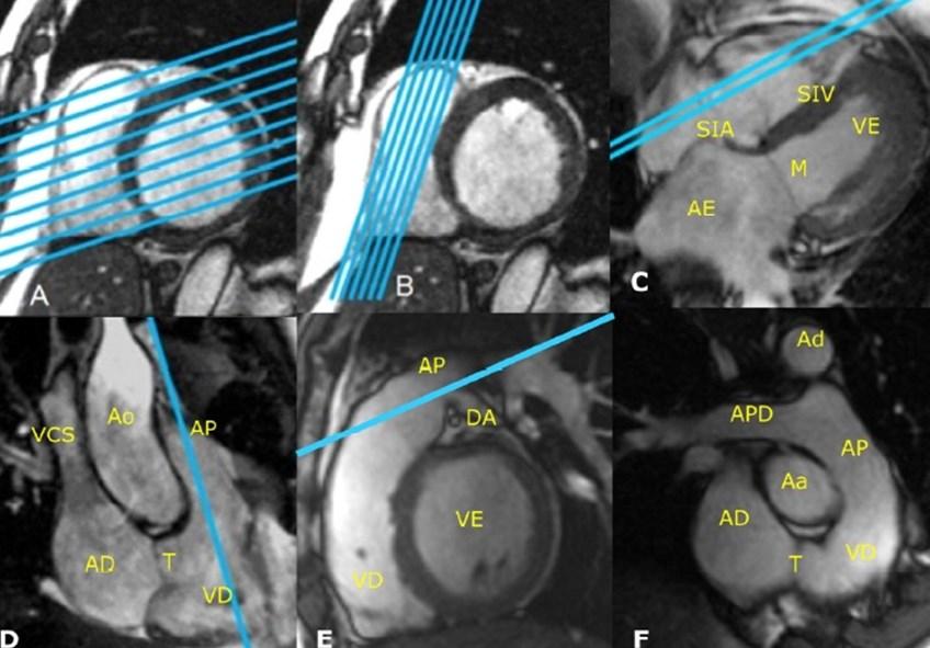 Diagnóstico de miocardite por ressonância magnética cardíaca 27 Figura 1 - Planejamento do estudo completo do ventrículo direito.