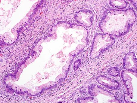 Cistoadenomas são revestidos por epitélio mucinoso simples, não-estratificado. 10% dos casos estão associados com tumores de Brenner ou cistos dermoides.