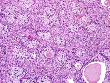 ovoides sem atipia. Mitoses são raras. Frequentemente são encontradas áreas de metaplasia mucinosa. Possuem comportamento benigno (5,24