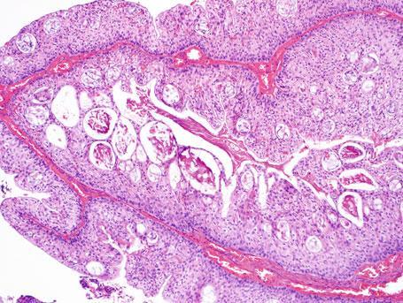 Figura 17 - Tumor de Brenner borderline. Fonte: Kurman, R; 2011 (5) 9.5.3.