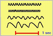 O aparelho de EEG registra através de eletrodos de captação posicionados sobre o escalpe as variações do potencial elétrico de várias frequências.