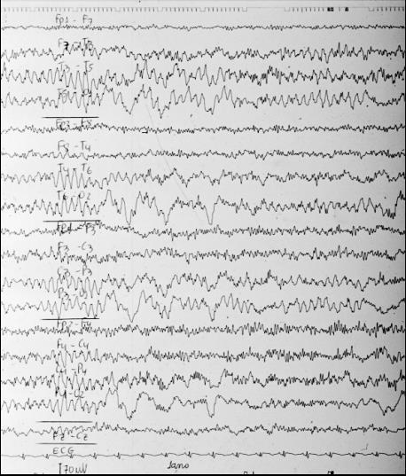 EEG de vigília em criança de 1 ano (ritmo posterior similar ao alfa,