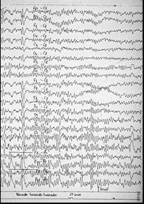 EEG de vigília de adolescente, relaxado (ritmo
